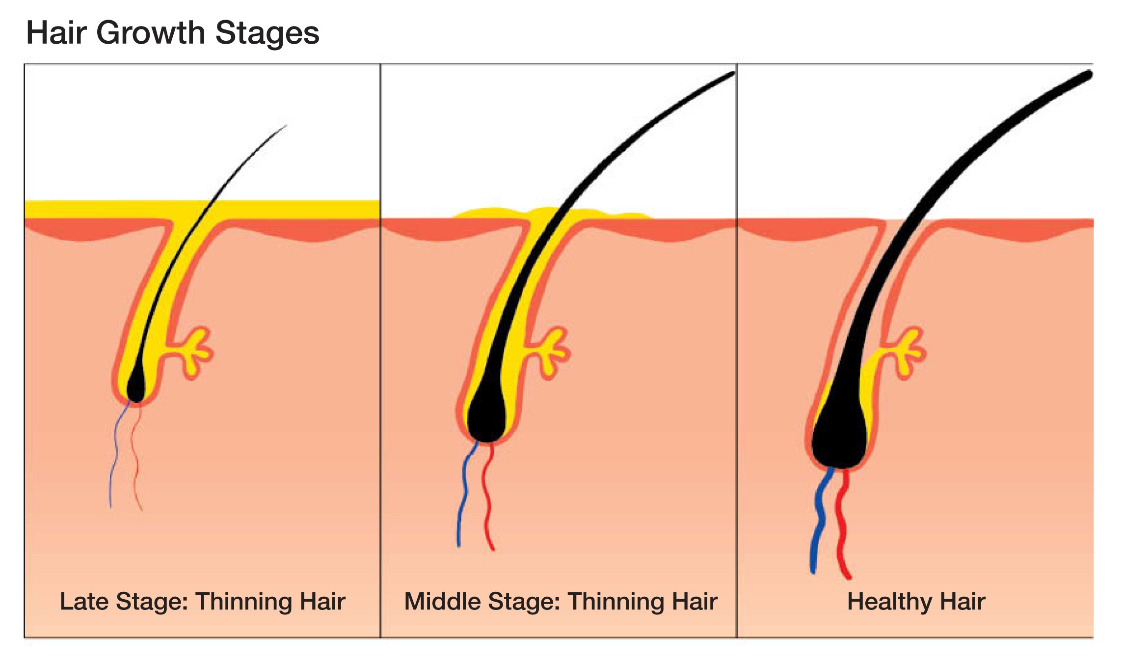 Surgery For Thinning Hair